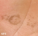 tinea nigra