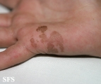 tinea nigra