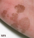 tinea nigra
