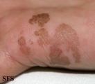 tinea nigra