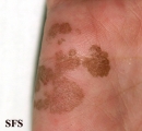 tinea nigra