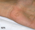 tinea nigra