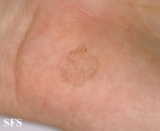 tinea nigra