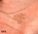 tinea nigra