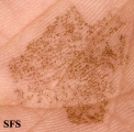 tinea nigra