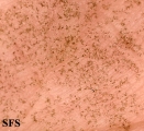 tinea nigra