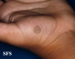 tinea nigra