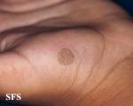 tinea nigra