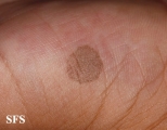 tinea nigra