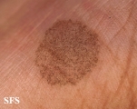 tinea nigra