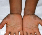 tinea nigra