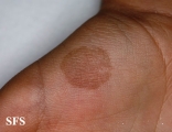 tinea nigra