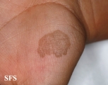 tinea nigra