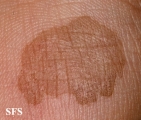 tinea nigra