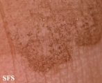 tinea nigra