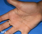 tinea nigra