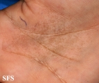 tinea nigra