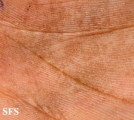 tinea nigra