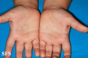 tinea nigra