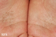 tinea nigra