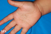tinea nigra