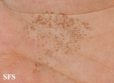 tinea nigra
