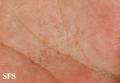 tinea nigra