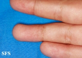 tinea nigra