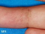 tinea nigra