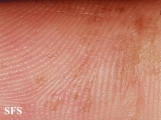 tinea nigra
