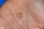 tinea nigra