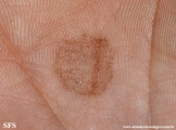 tinea nigra