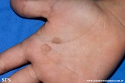 tinea nigra