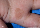 tinea nigra