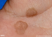 tinea nigra