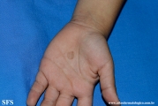 tinea nigra
