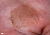 tinea nigra
