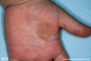 tinea nigra