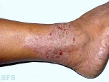 stasis eczema