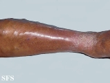 stasis eczema