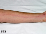 lymphangitis-acute lymphangitis
