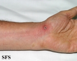 lymphangitis-acute lymphangitis