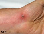 lymphangitis-acute lymphangitis
