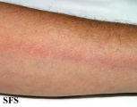 lymphangitis-acute lymphangitis