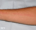 lymphangitis-acute lymphangitis