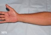 lymphangitis-acute lymphangitis