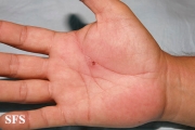 lymphangitis-acute lymphangitis