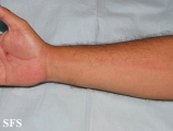 lymphangitis-acute lymphangitis