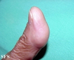 tenosynovitis nodular