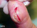 tenosynovitis nodular